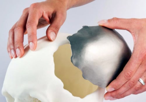How is 3d printing used to create custom implants and prosthetics?